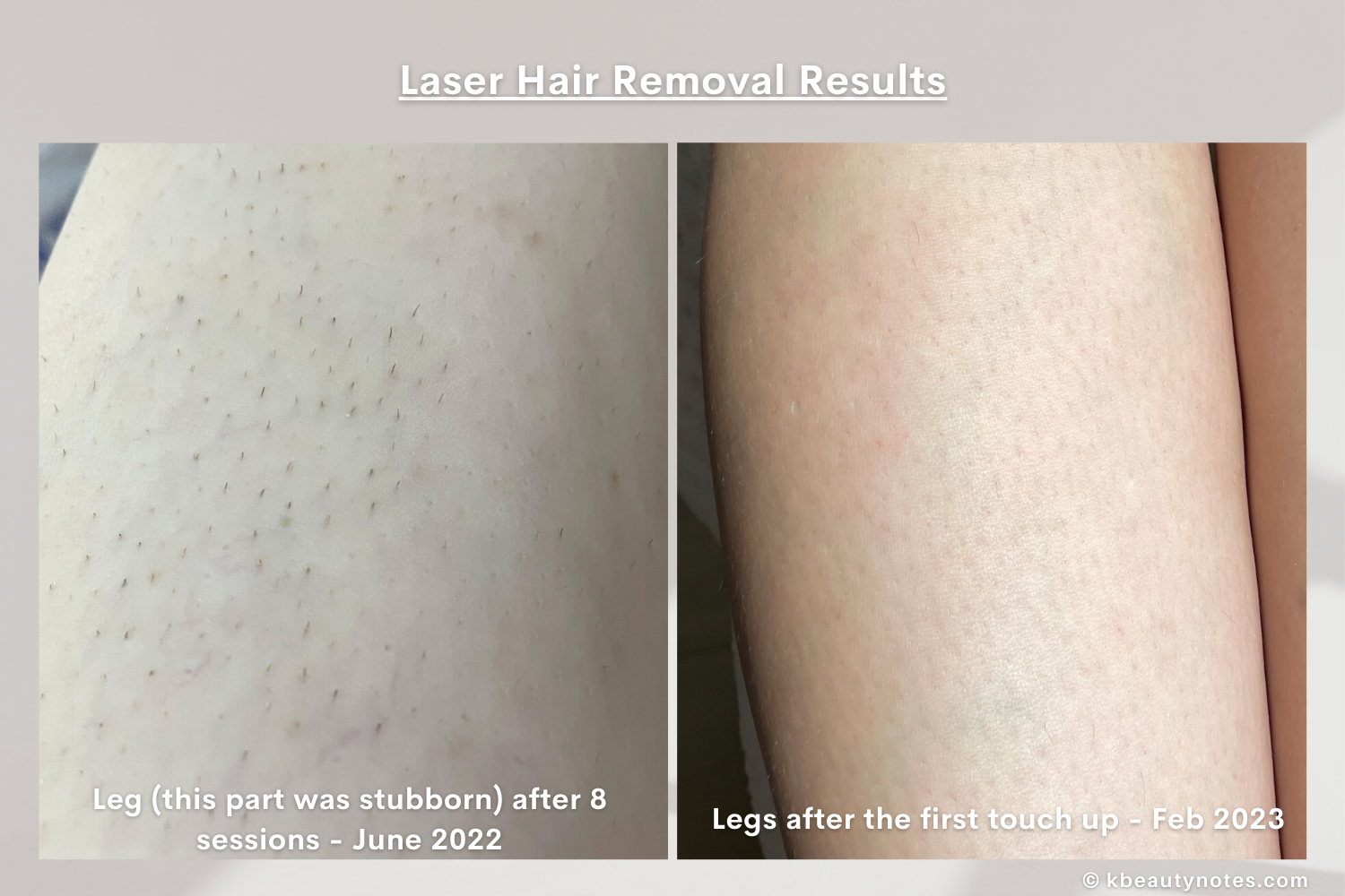 Body Laser Hair Removal