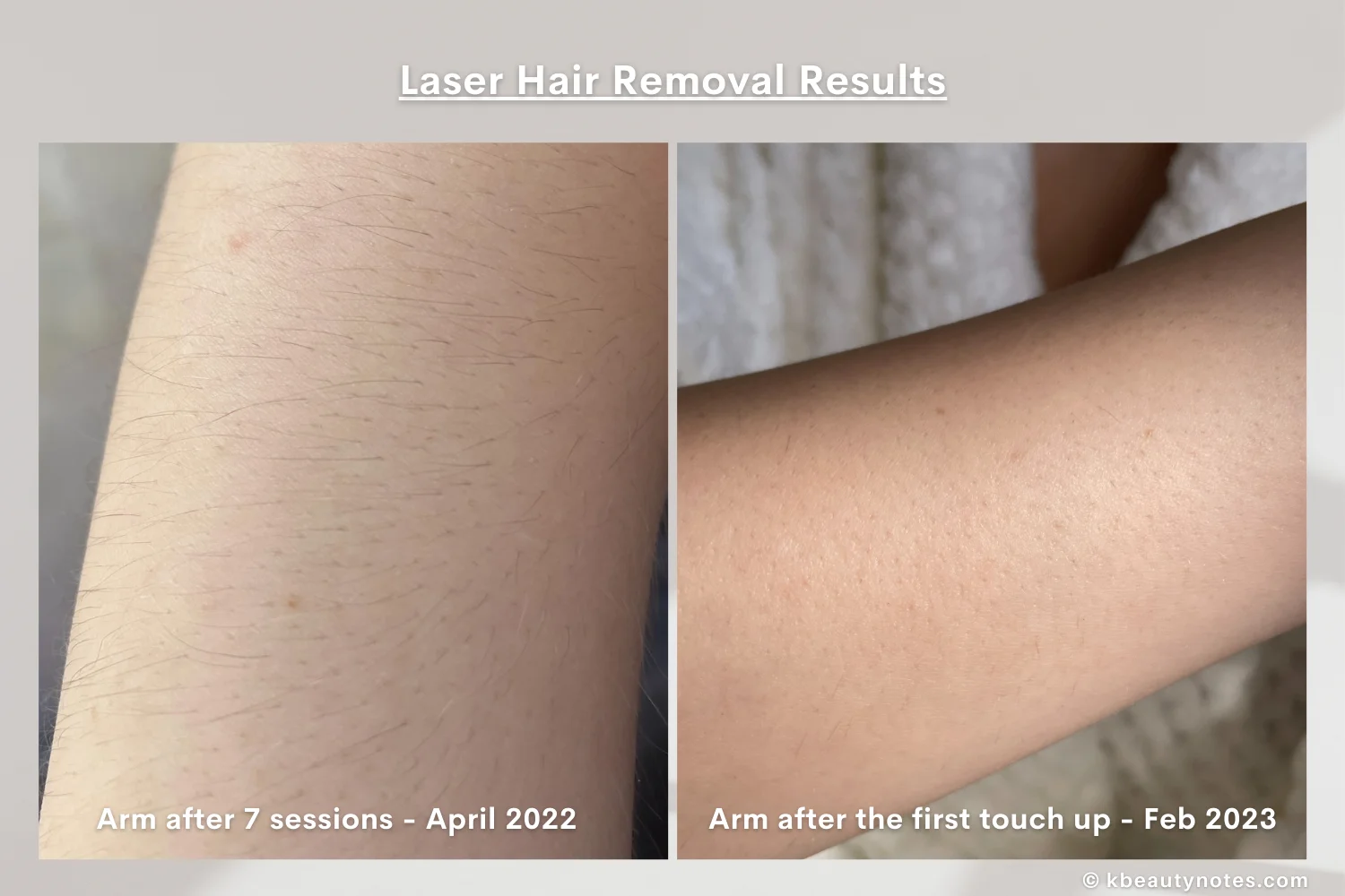 My Experience With Total Body Laser Hair Removal 2022 Before And After 